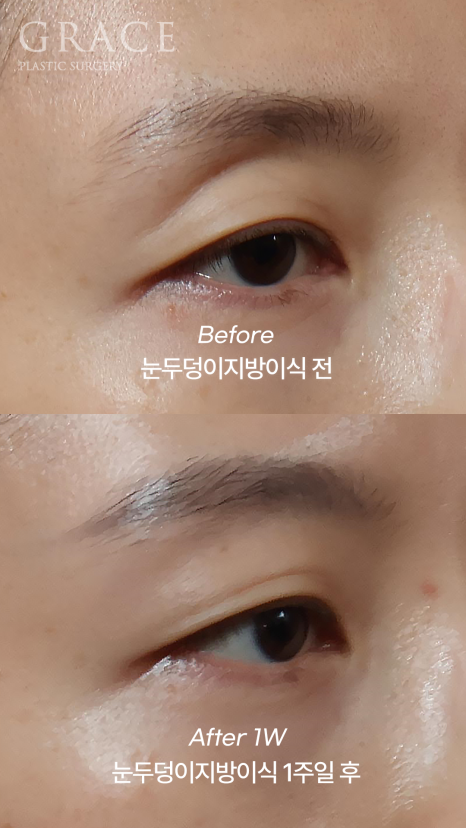 The Basis for a 94.5% Functional Improvement: Fat Grafting Technology That Fills in a Sunken Eye Hollow image 3