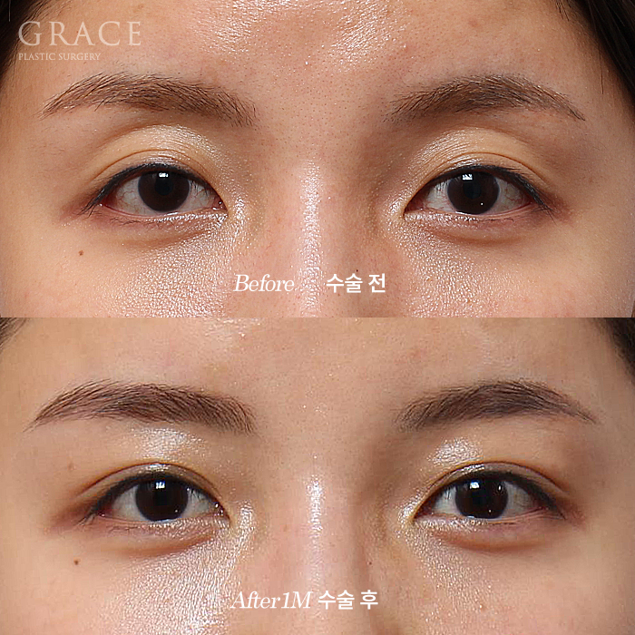 Why It’s Not Always Better Just Because Lower Eyelid Fat Grafting Is Cheap image 5
