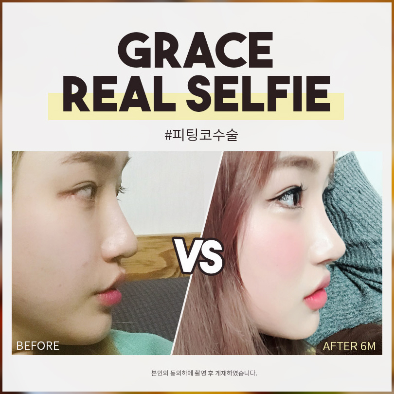 주먹코수술 엣지있게 예뻐지자! 관련 이미지 2