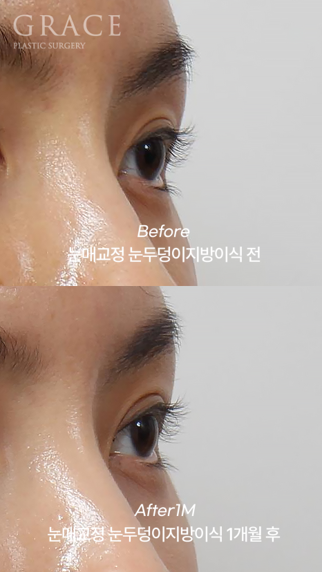 Side Effects of Eyelid Fat Grafting? One-Month Engraftment Period When Eyelid Correction Is Performed image 4