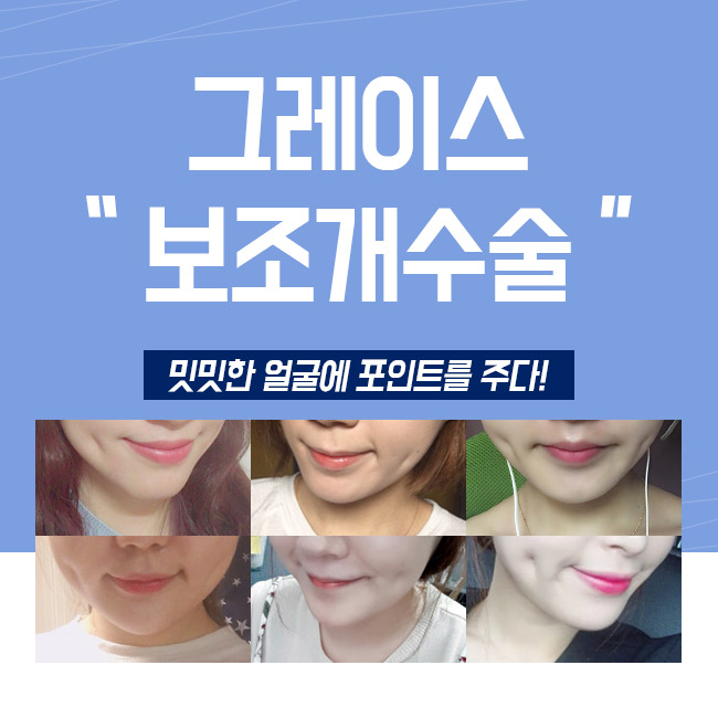 놀라운 변화 보조개수술후기를 만나보세요 관련 이미지 3