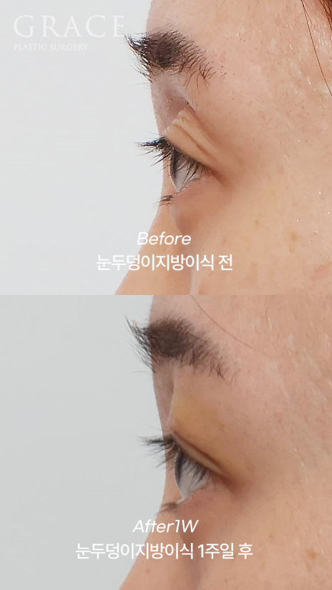 Understanding the Difference Between Forehead Fat Grafting (Eye Hollow Fat Grafting) and Fillers image 5
