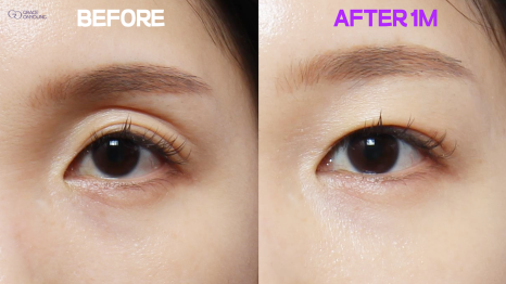 Revealing Why Fat Graft Is Placed into the Orbital Fat in the Upper Eyelid image 11