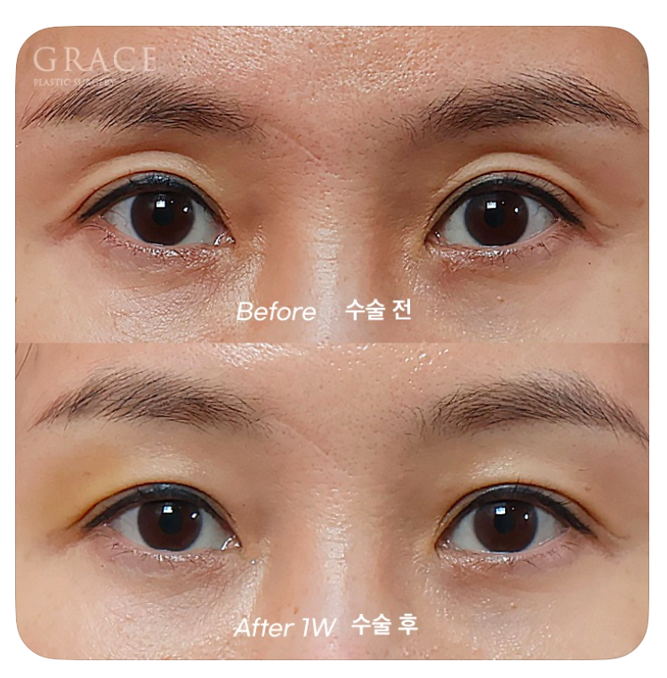Causes of Sunken Eyelids and How Eyelid Fat Grafting Can Change Your Impression image 2