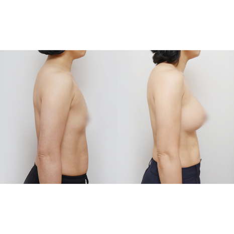 Is Getting 360cc Motiva Implants All It Takes? The Real Difference Is Vertical Rearrangement image 2