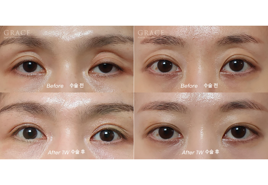 꺼진 눈두덩이 지방이식 잘하는 곳 유명한 이유가 있습니다. (칼럼) 관련 이미지 3
