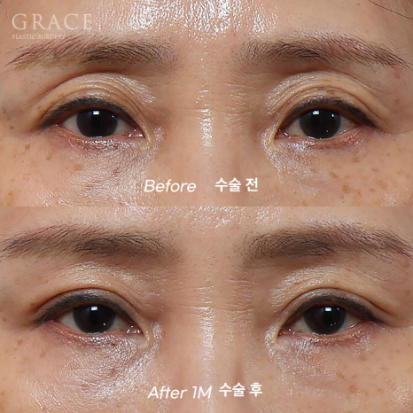 Is Upper Blepharoplasty Necessary at 58? Swelling Side Effects After Non-Incisional Ptosis Correction and Upper Eyelid Fat Grafting image 2