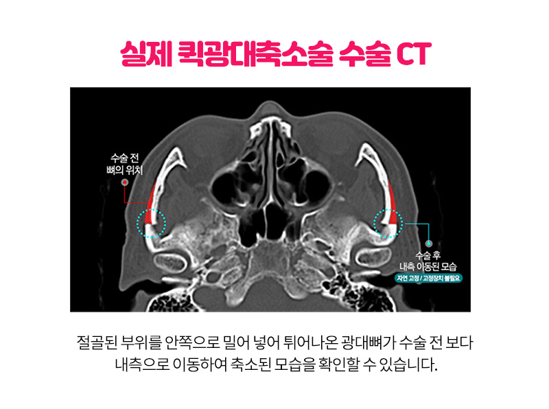 그레이스성형외과 퀵광대축소술 11월&hearts; 관련 이미지 3