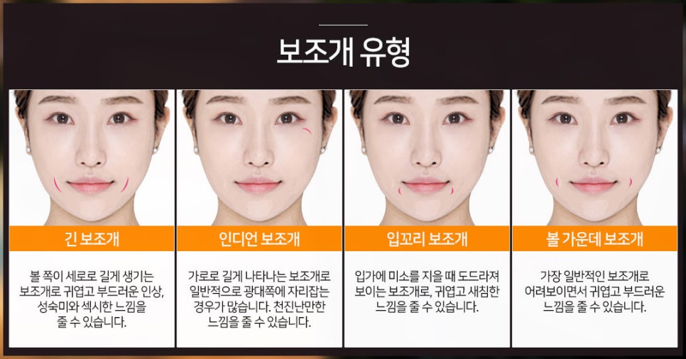 보조개수술전후, 매력 포인트를 주다! 관련 이미지 4