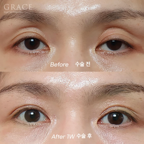 Grace Plastic Surgery’s Approach to Diagnosing Hollow Eye Socket Fat Grafting from the Structure image 3