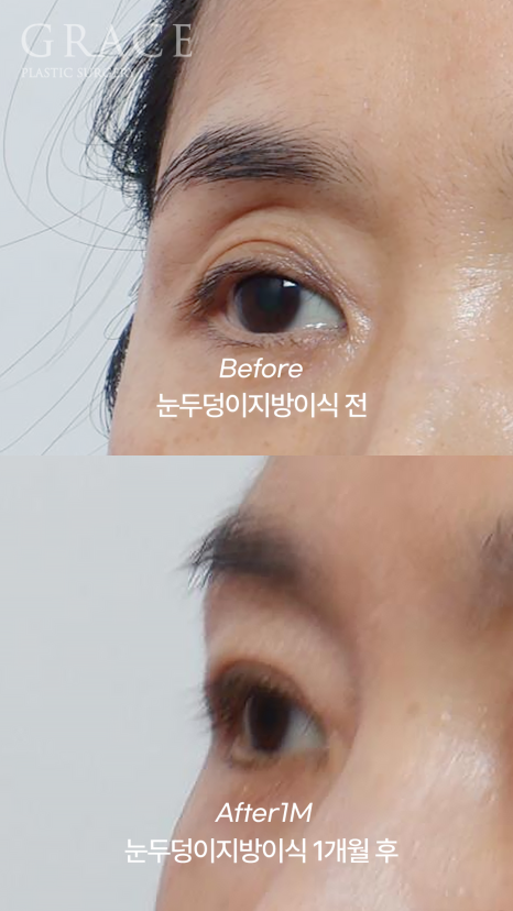 눈꺼풀 지방이식 절개 없이 아이홀 부위를 채우기 관련 이미지 5