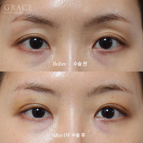 그레이스성형외과 Before&middot;After 아이홀 지방이식 잘하는 곳 관련 이미지 2