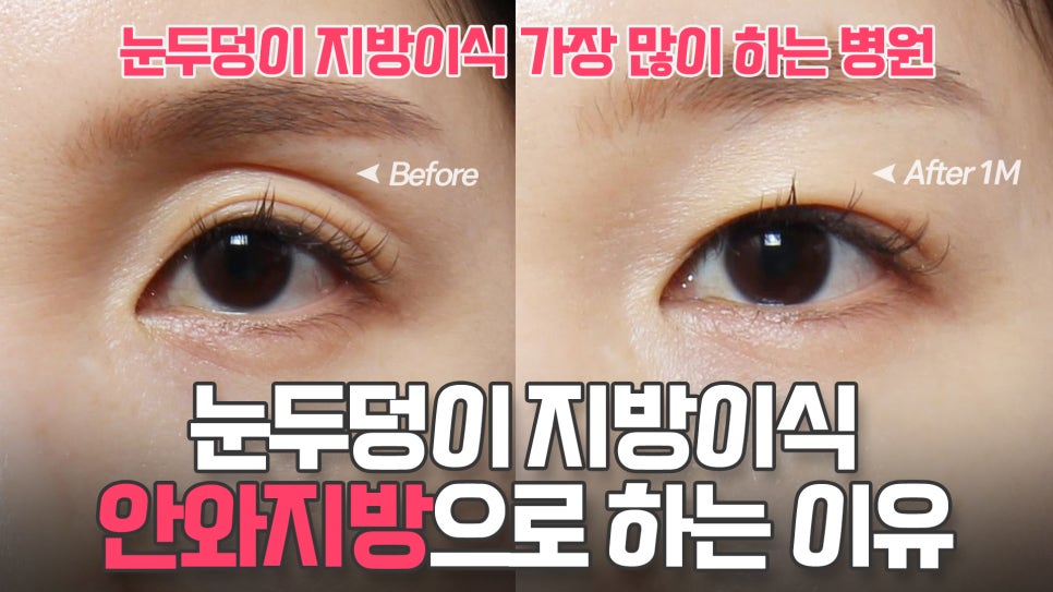 Revealing Why Fat Graft Is Placed into the Orbital Fat in the Upper Eyelid image 13