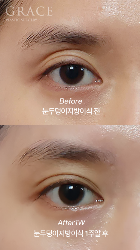 Recovery Timeline Before and After Eyelid Orbital Fat Grafting: 1 Week image 3