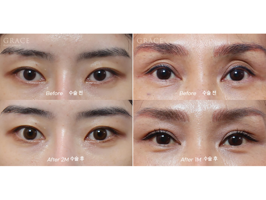 What Matters More Than Swelling After Eye Hollow Fat Grafting: Injection Location and Survival image 2