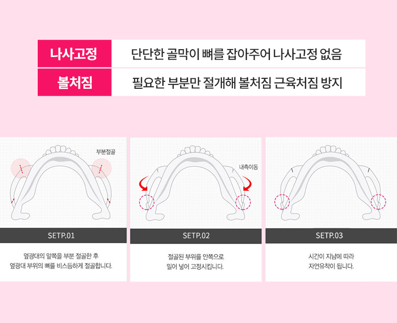 그레이스성형외과 퀵광대축소술 11월&hearts; 관련 이미지 2