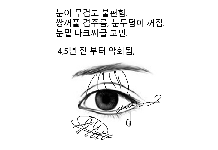 20년 전 쌍꺼풀 수술 겹쌍꺼풀에 눈두덩이 꺼짐까지? 아이홀 지방이식 재수 관련 이미지 1
