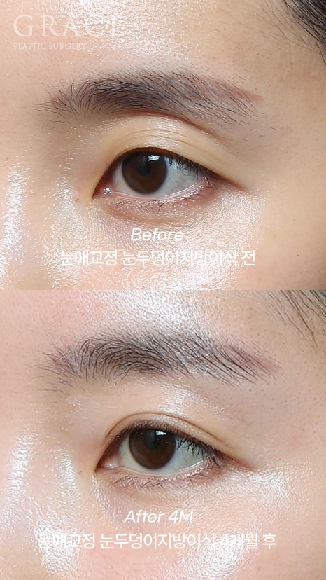 Review of 1cc Eyelid Fat Grafting for Sunken Upper Eyelids (Mid-30s, 4 Months Post-op Swelling and Scarring) image 6