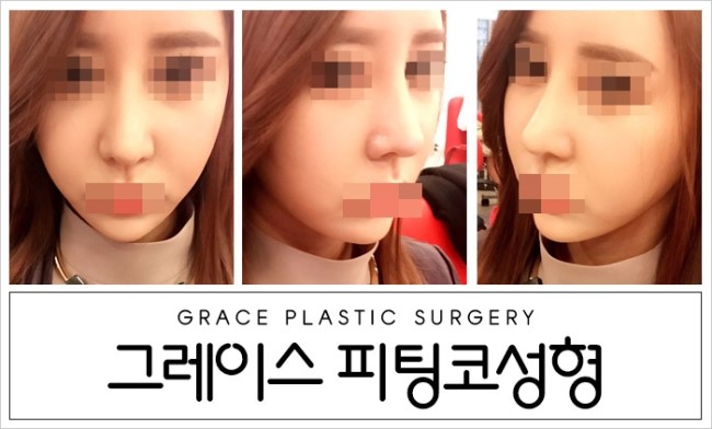 그레이스성형외과 피팅코, 자유자재로 움직이는 코를 선사하다! 관련 이미지 2