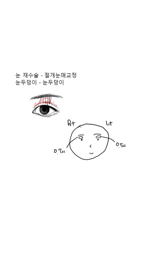 50대 눈두덩이지방이식 전후|그레이스성형외과 관련 이미지 6