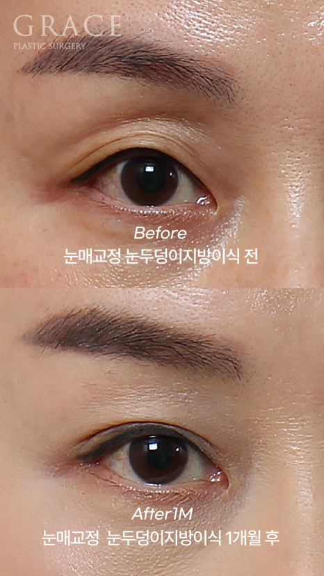눈두덩이 지방이식 비절개 눈매교정 반드시 필요할까? (초이칼럼) 관련 이미지 2