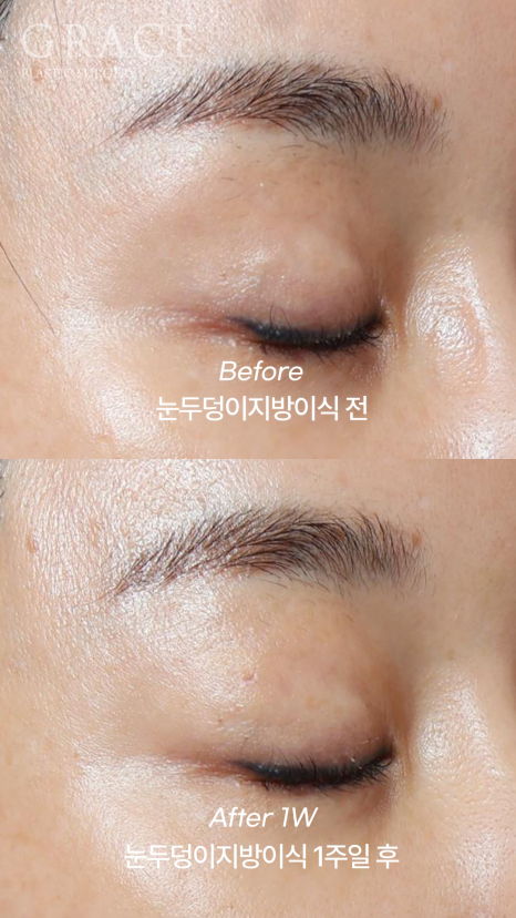 돌출눈성형 전후 움푹 패인 눈꺼풀 지방이식 관련 이미지 3