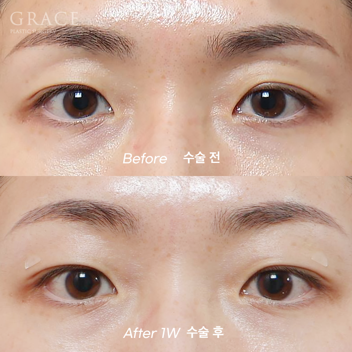 Eyebrow Fat Grafting &middot; Eyelid Fat Grafting &middot; Sunken Eyes Surgery Cost Information (As of June 2025) image 1