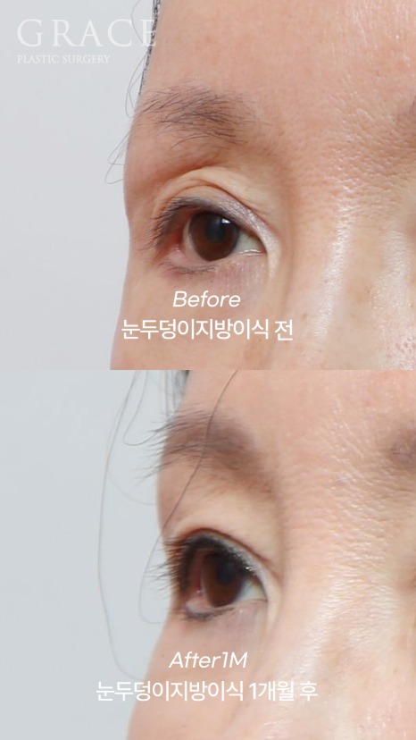 꺼진 아이홀 눈꺼풀 지방이식 (얇은 피부 부작용 붓기 등) 관련 이미지 3