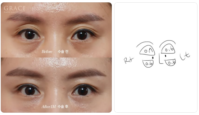 The Real Cause of Side Effects from Upper Eyelid Fat Grafting: the Injection Layer (Orbicularis Oculi Muscle & Orbital Fat) image 5