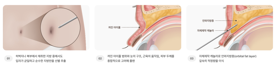 If You’re Curious About Eyelid Fat Grafting Reviews, Costs, Prices, and Side Effects image 6