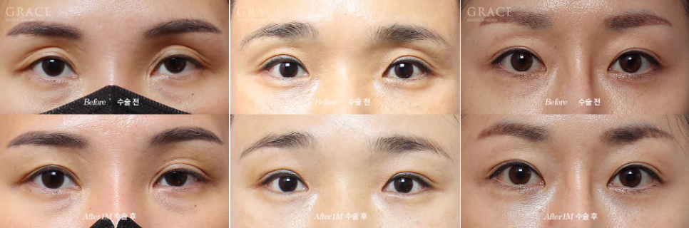 Why Does Fat Grafting to the Upper Eyelids Require a Different Approach from the Lower Eyelids? image 5