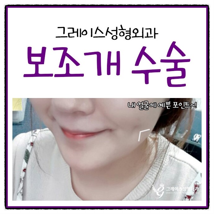 보조개수술후기 보고 심쿵한 매력♡ 관련 이미지 4