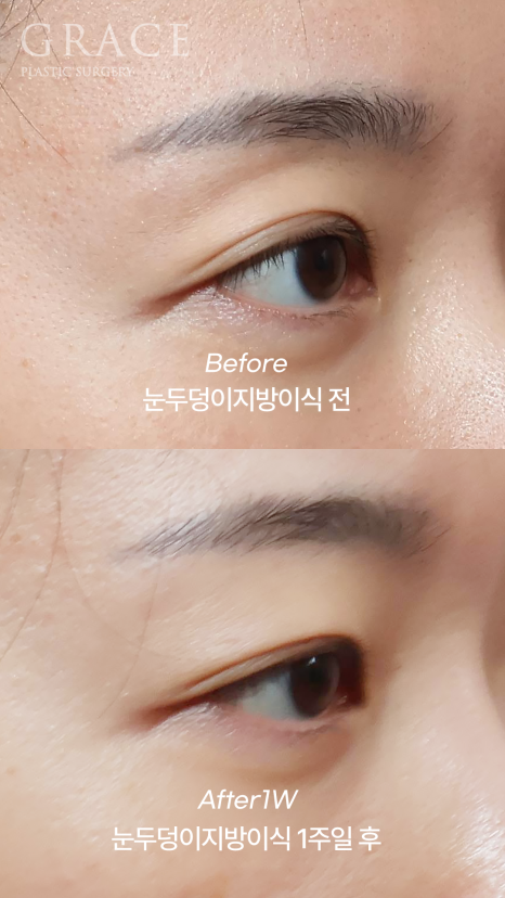 No to Frozen Fat That’s Completely Frozen! Eyelid Fat Grafting with Only Fresh Autologous Fat image 3