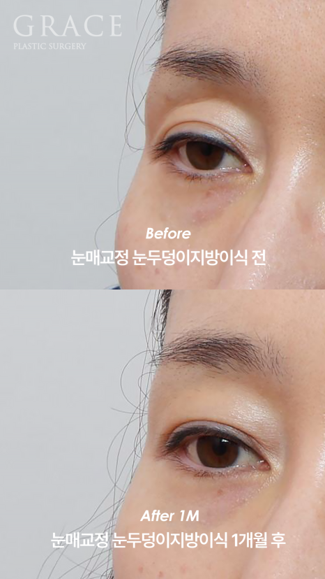 What Is the Problem with the Side Effects of a Lumpy Eyelid Fat Graft? image 7