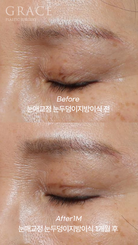 Is Upper Blepharoplasty Necessary at 58? Swelling Side Effects After Non-Incisional Ptosis Correction and Upper Eyelid Fat Grafting image 5