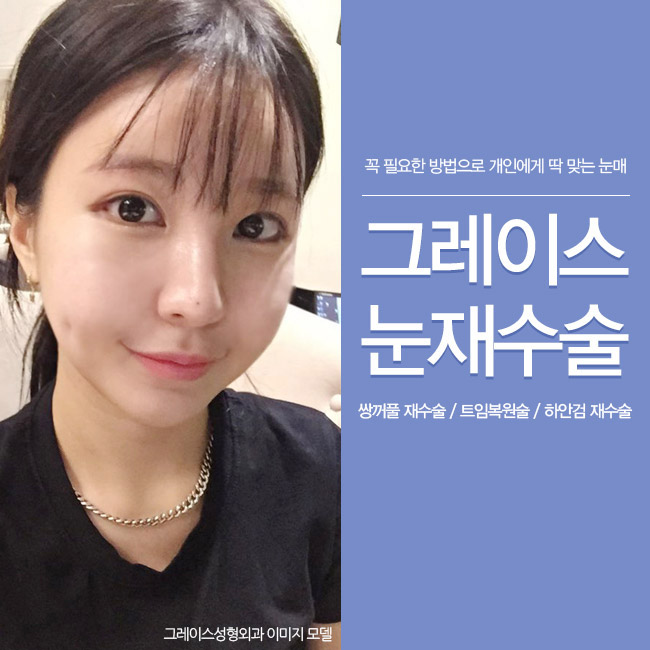 재발한 안검하수 그레이스성형외과에서 해결! 관련 이미지 3