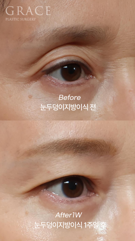 눈두덩이 지방이식 유지기간과 부작용까지 한 번에 정리 관련 이미지 5