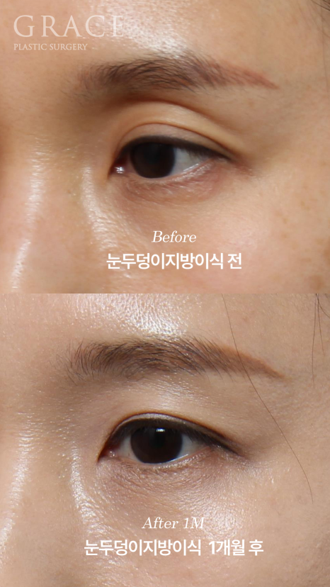 The Key to Improving Sunken Eyelids with Orbital Fat Grafting Is Placement, Not Volume image 5