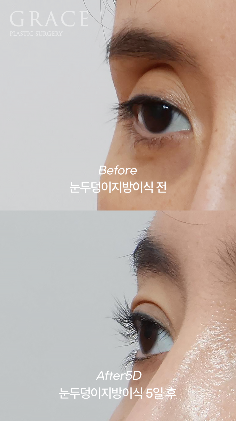 Upper Eyelid Fat Grafting, Yellow Bruising and Swelling (... Changes Noted After 5 Days) image 5