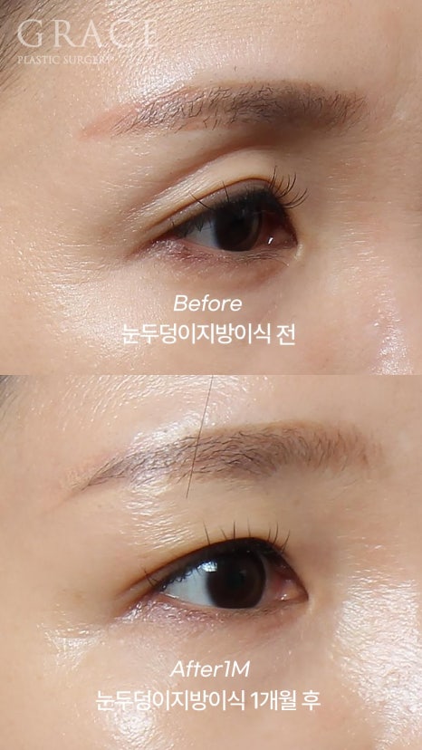 Eyebrow Hollow Fat Grafting Before and After Comparison – Gently Filling Sunken Eyes image 17