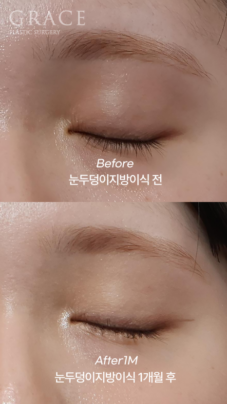 In Your Mid-20s, If You Have Ptosis Before and After Upper Eyelid Fat Grafting, Is Eye Correction Essential? image 5