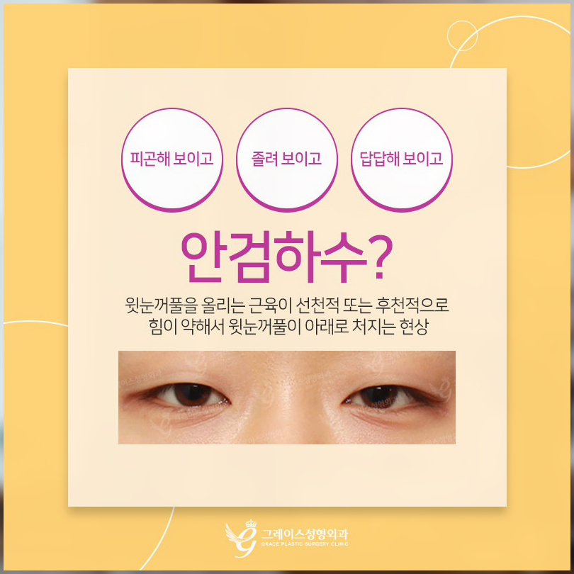 눈꺼풀처짐 안검하수증상으로 힘들다면? 관련 이미지 2