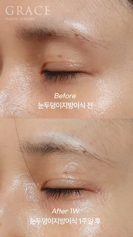 눈꺼풀 지방이식 눈 감았을 때 울퉁불퉁하지 않는 이유 전후사례로 보여드립니다 관련 이미지 4