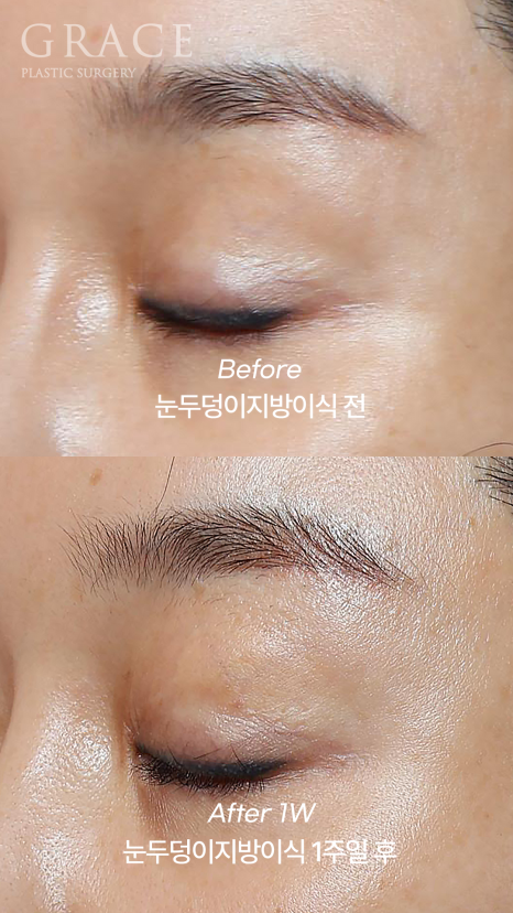 돌출눈성형 전후 움푹 패인 눈꺼풀 지방이식 관련 이미지 6