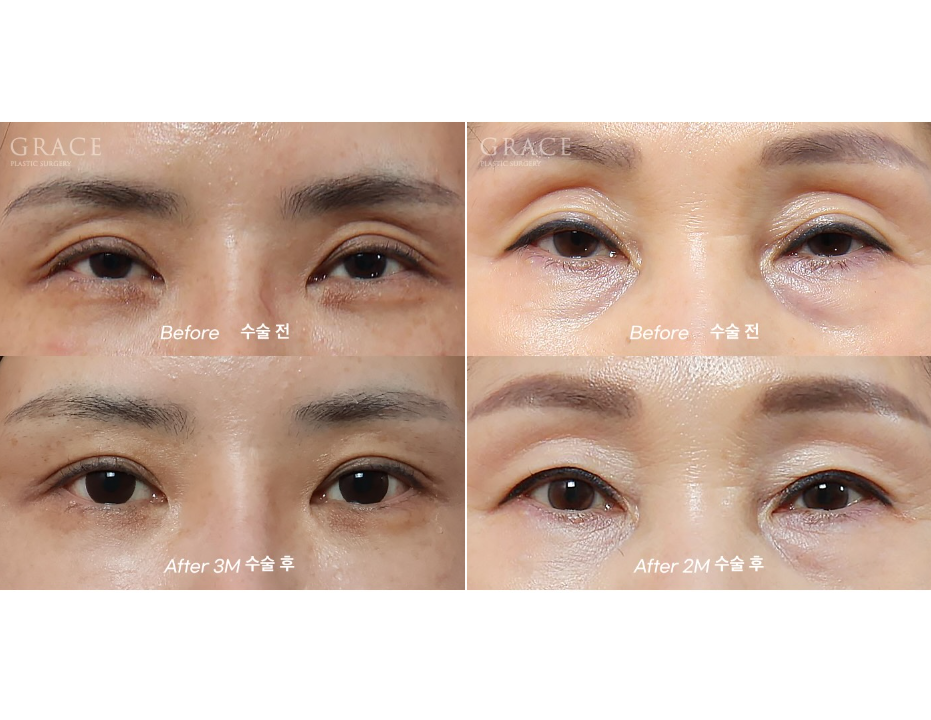 Grace Plastic Surgery Sunken Eye Hollows Upper Eyelid Fat Grafting image 3