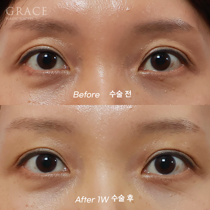 Fat Removal After Double Eyelid Surgery? Eyelid Fat Grafting After Double Eyelid Surgery Before & After image 1