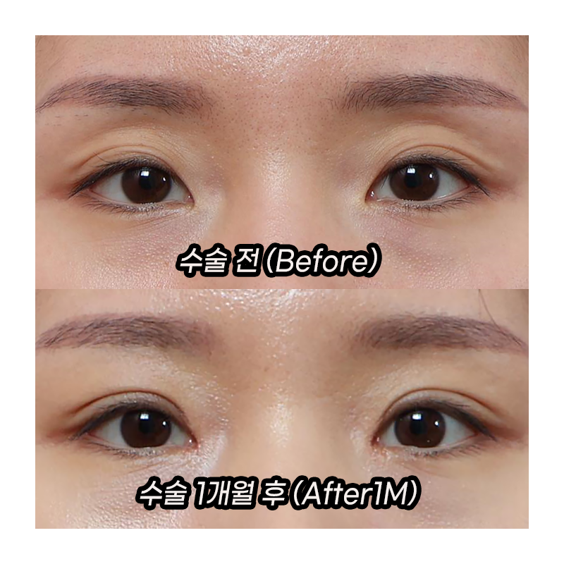 Before and After Upper Eyelid Fat Grafting for Women in Their Early 30s image 1