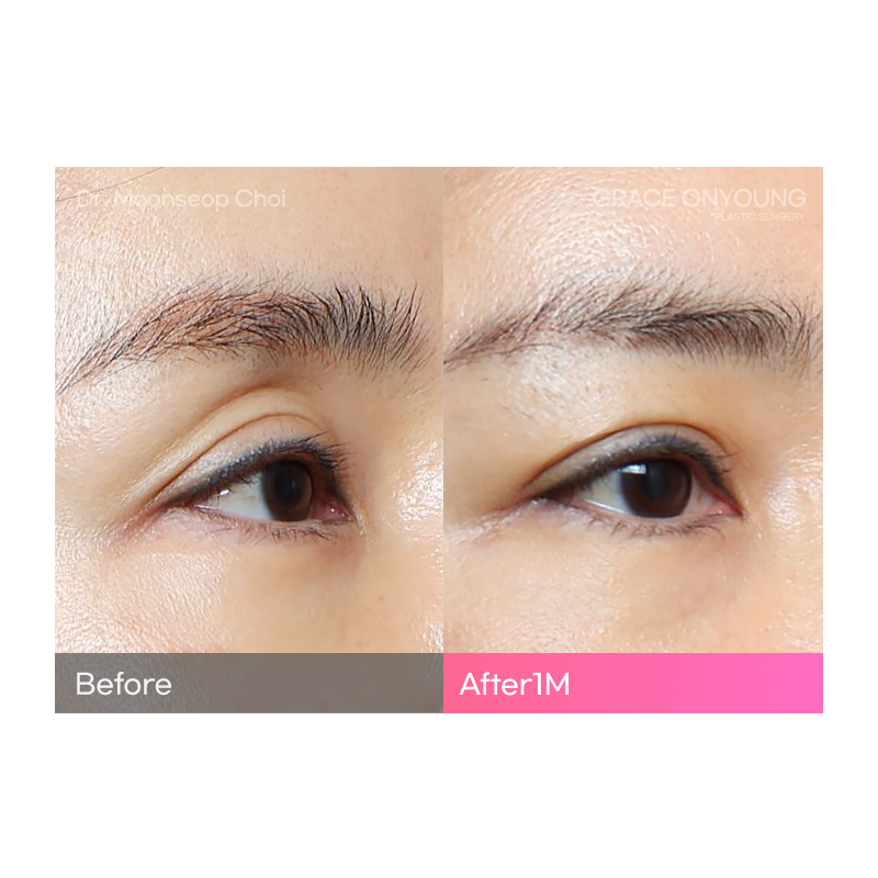 Are You Considering Fat Grafting for Hollow Upper Eyelids? image 1