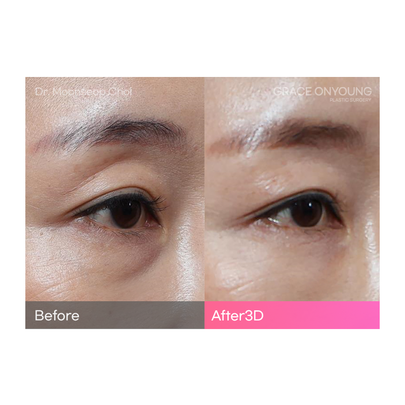 Are You Considering Fat Grafting for Hollow Upper Eyelids? image 5