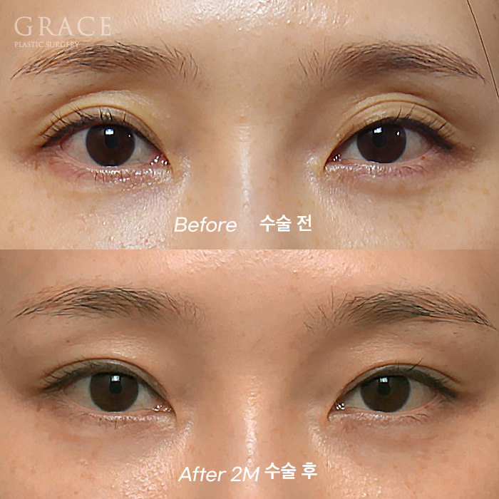 Will Eye Hollow Fat Grafting Really Deflate After 1 Month? 1-Week vs 2-Month Before-and-After Comparison image 2